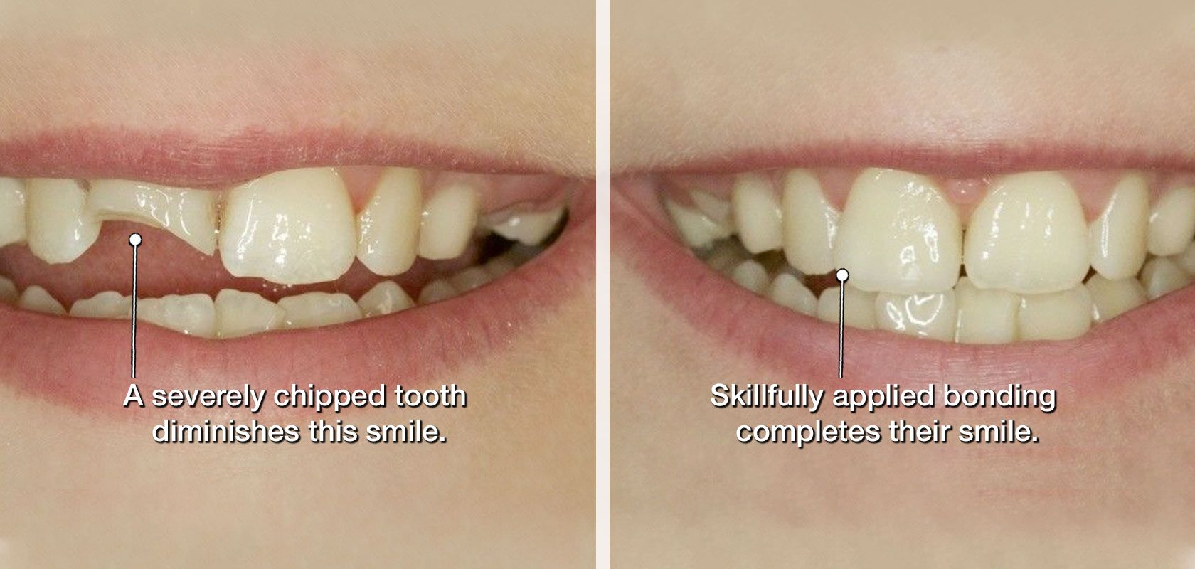 Before and after dental bonding placement