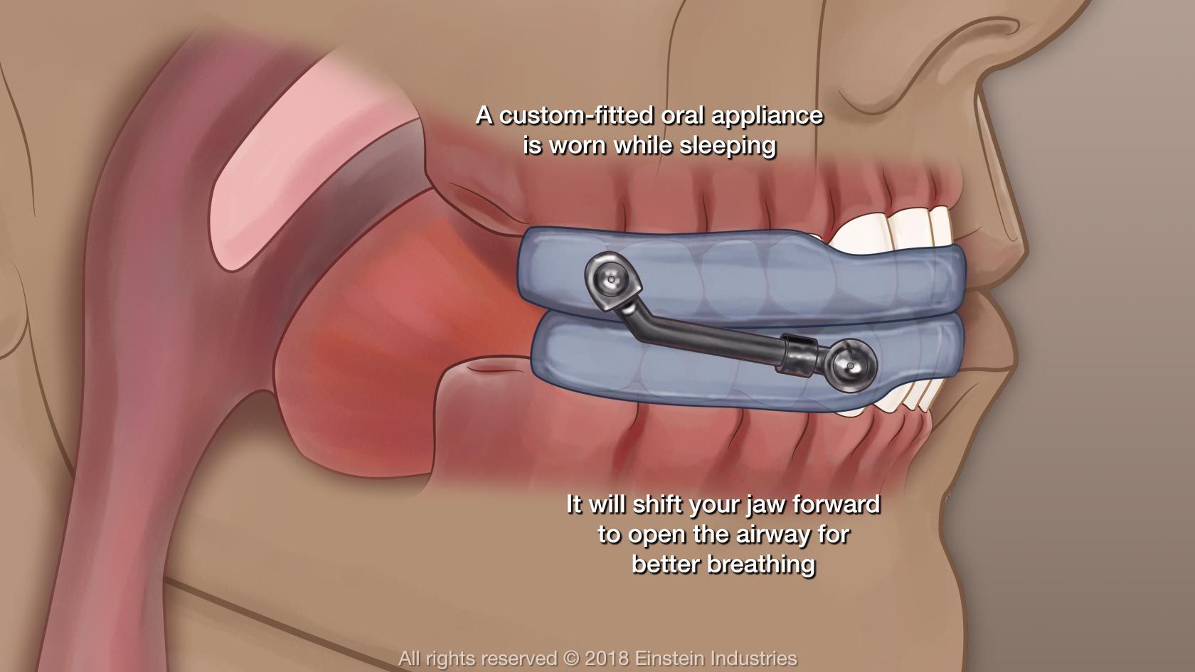 Sleep apnea treatment illustration