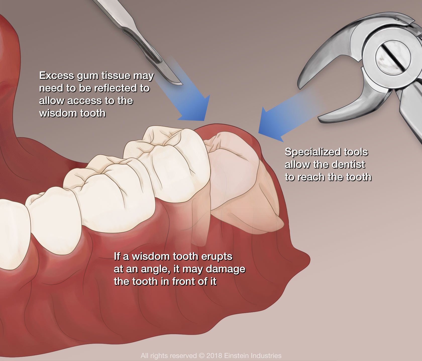 Demonstration of wisdom tooth extraction