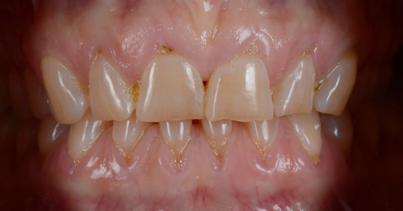 Before cosmetic dentistry treatment