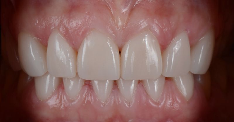 After cosmetic dentistry treatment