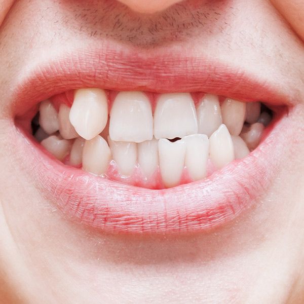 Close up of misaligned front teeth